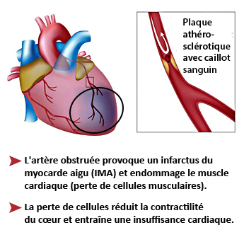 Carroussel FR - AMI heart